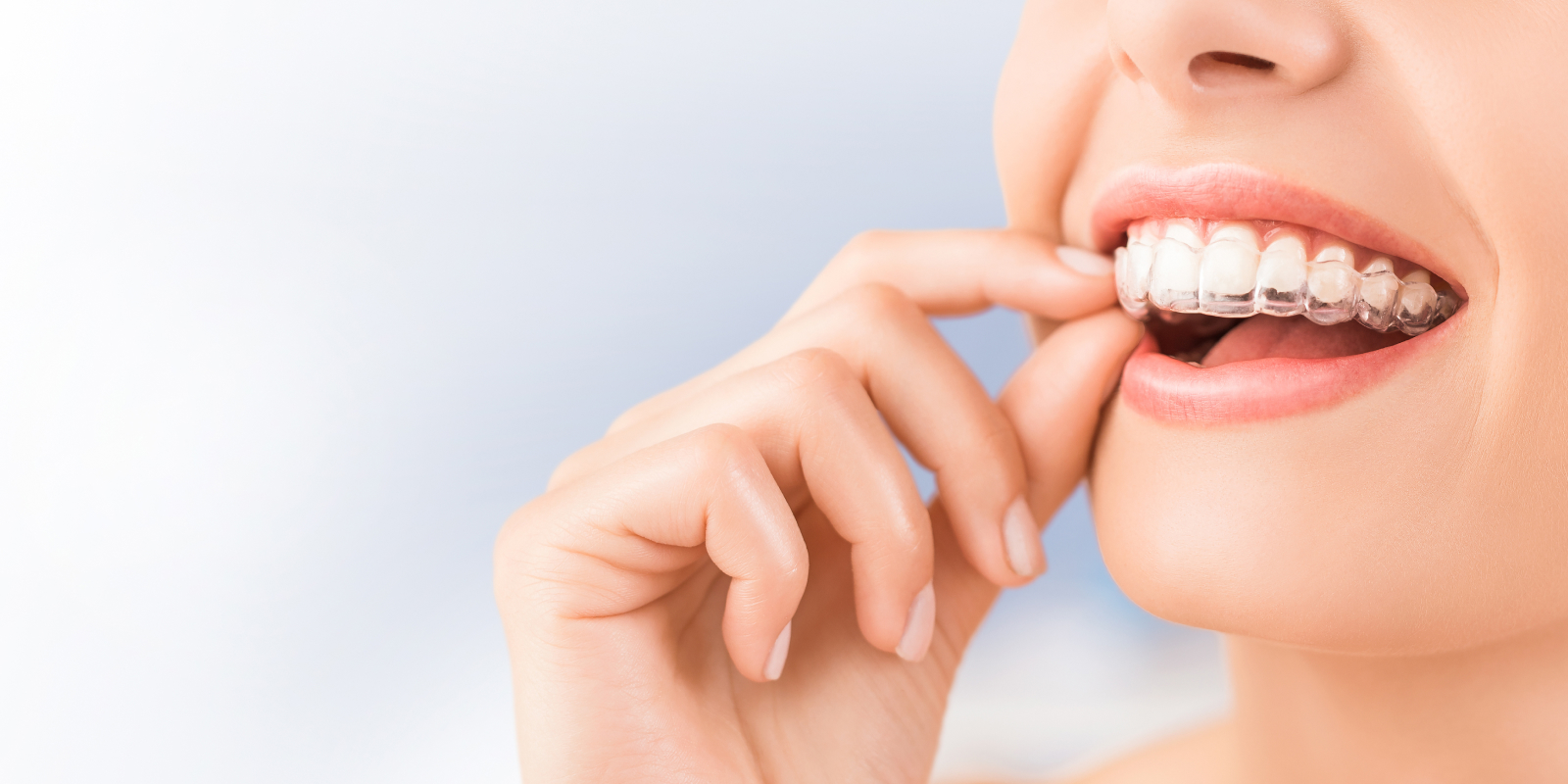 マウスピース矯正